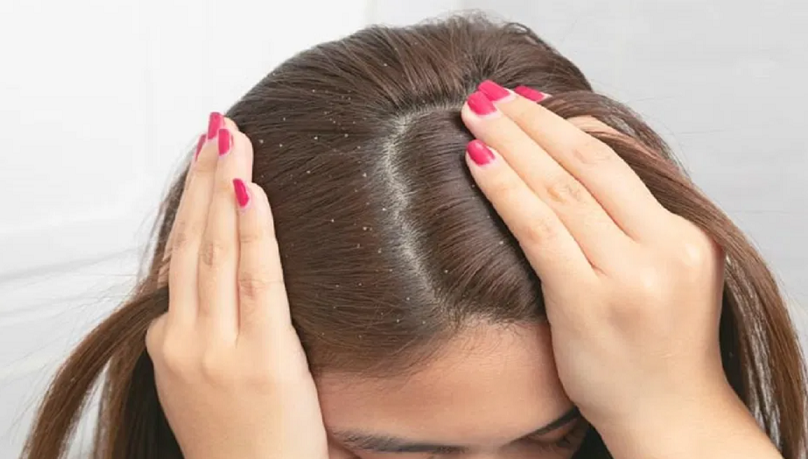 Dandruff Tips: చుండ్రు సమస్యతో జుట్టు ఊడిపోతుందా? ఈ టిప్స్‌తో సమస్యకు చెక్..