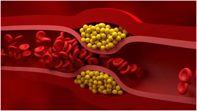 Bad Cholesterol : చెడు కొలెస్ట్రాల్ను కరిగించే చిట్కా.. మన ఇంట్లోనే..!