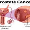 PROSTATE CANCER SYMPTOMS