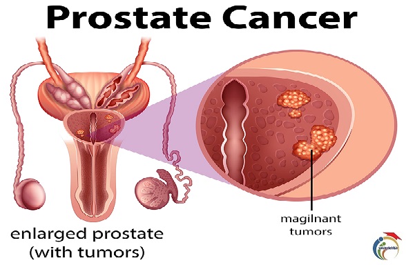 PROSTATE CANCER SYMPTOMS